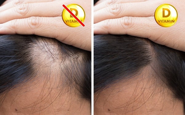 Is Hair Loss Due To Vitamin D Deficiency Reversible?