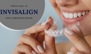 5 Advantages of Invisalign over traditional braces