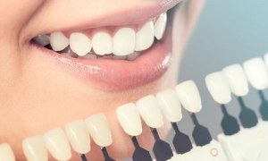 Few things to know before taking up the Invisalign procedure