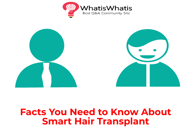 Facts You Need to Know About Smart Hair Transplant